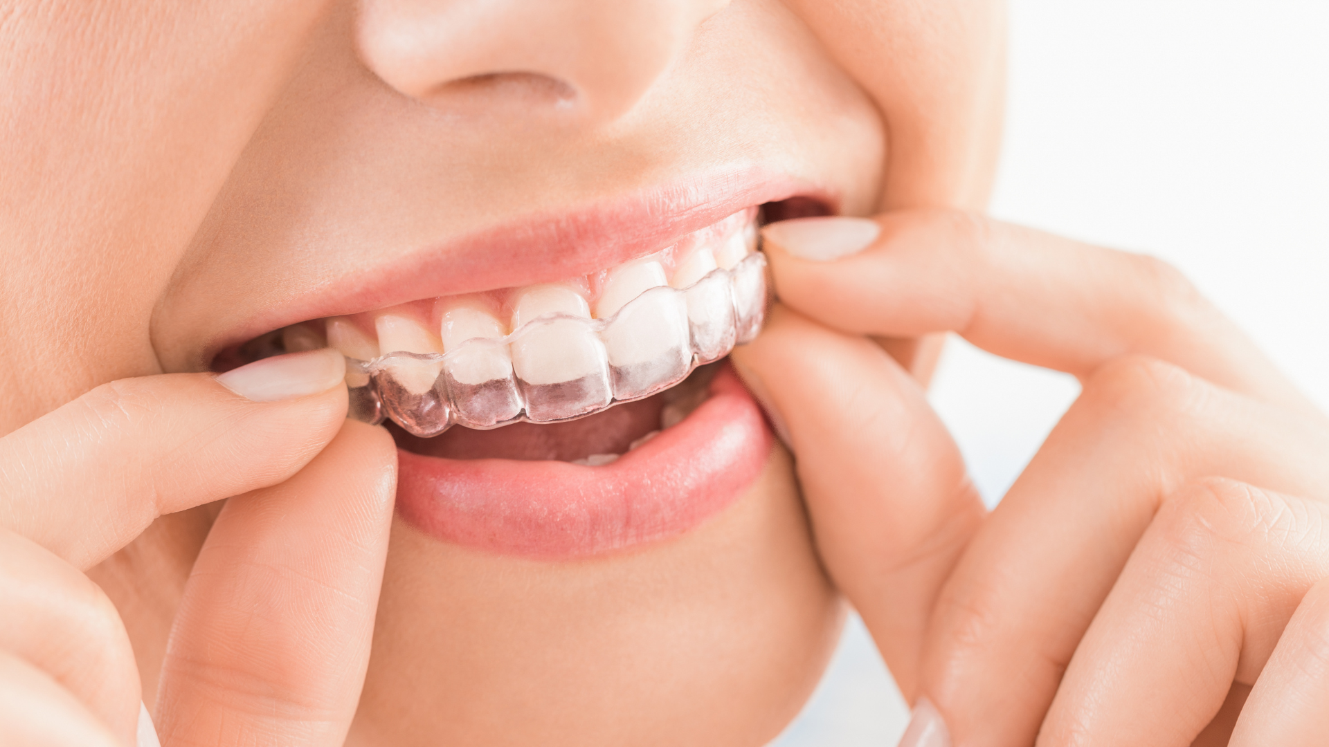 Woman inserting clear aligners into her mouth.