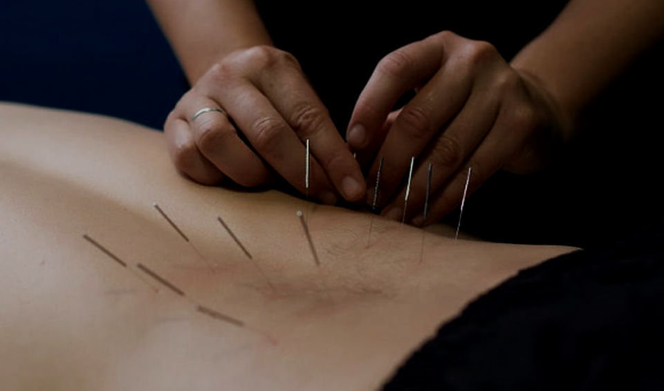 A practitioner inserts fine acupuncture needles into a patient’s back during a treatment session.