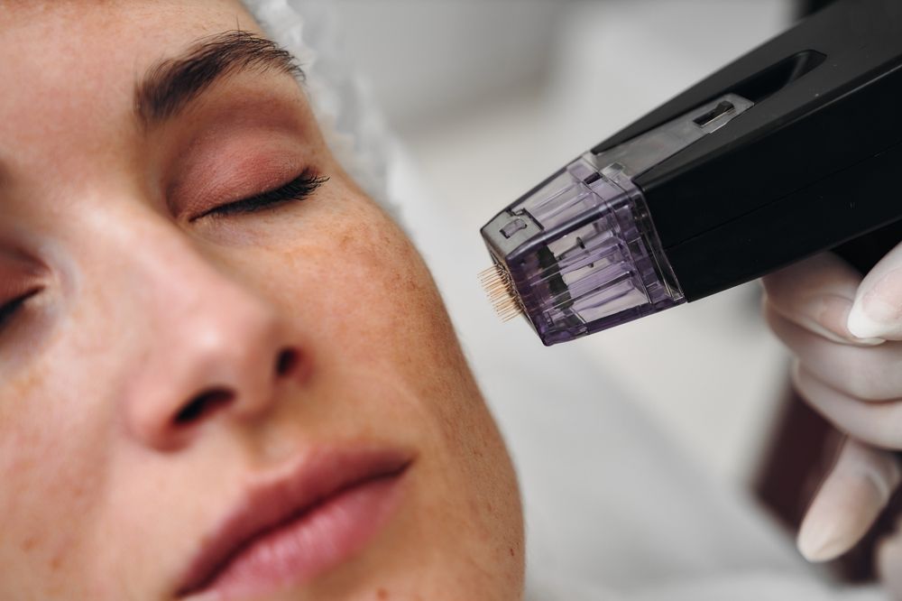 Woman undergoing microneedling treatment on her face with a specialized device.