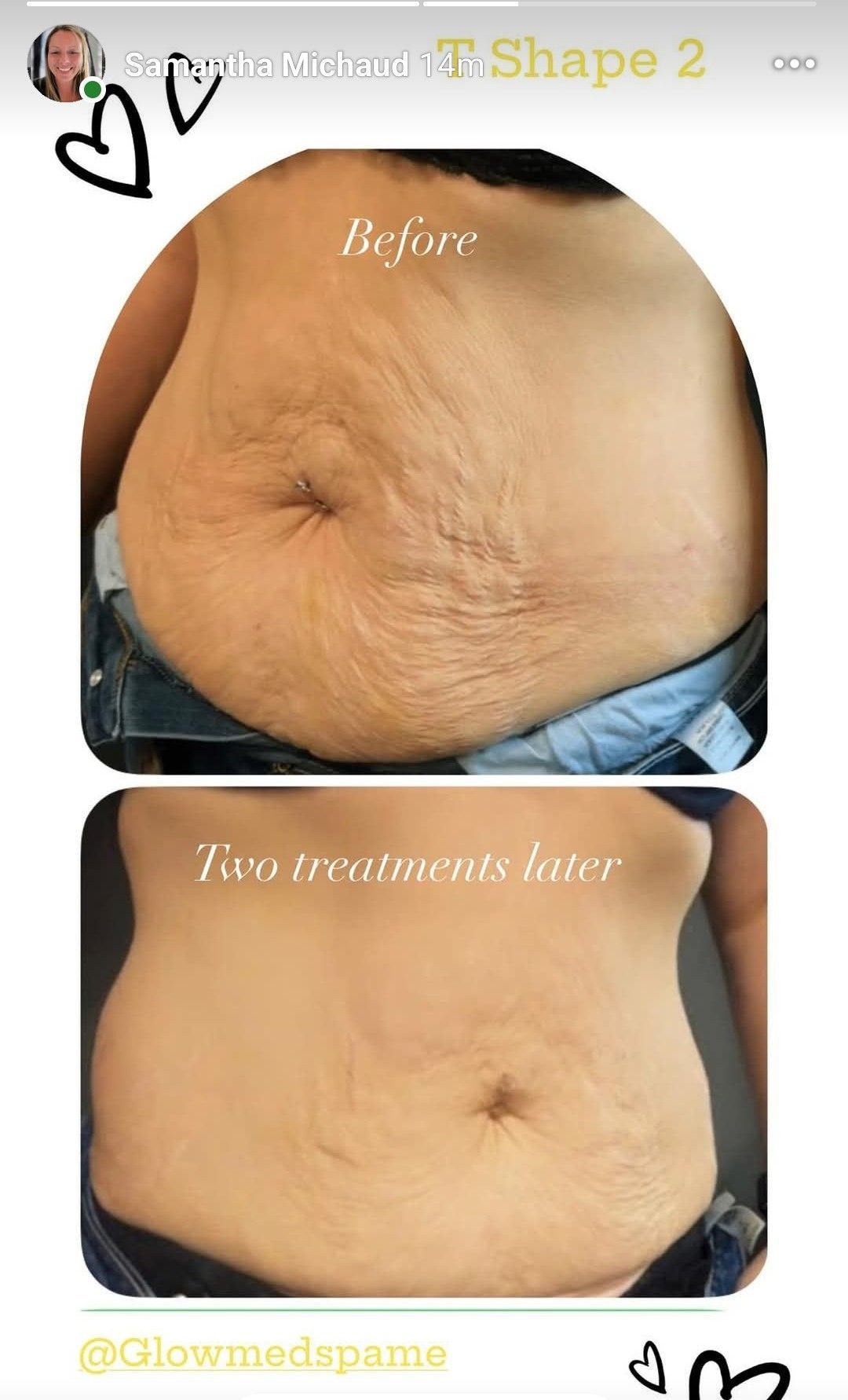 Before-and-after belly photos showing reduced abdominal skin folds after treatment.