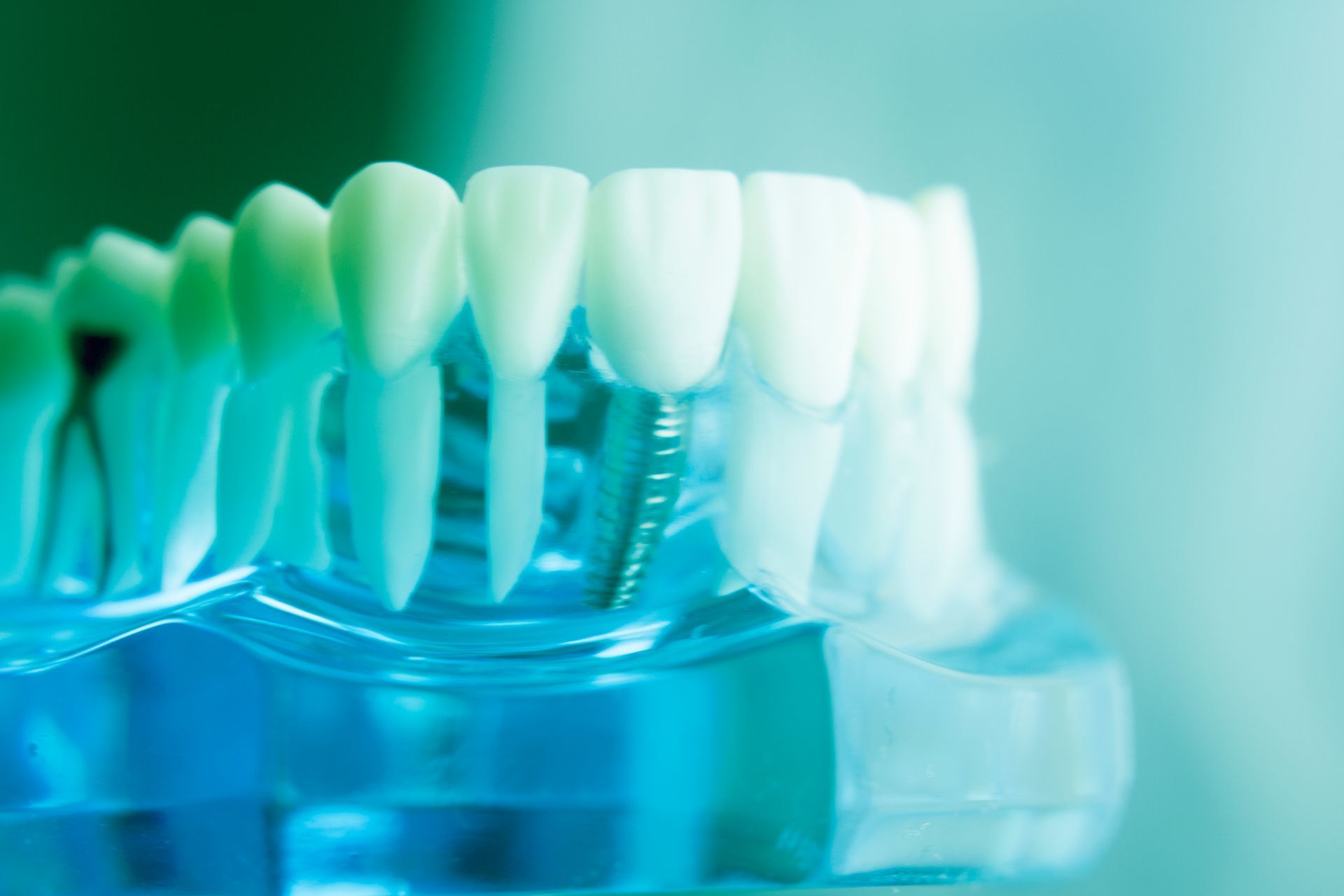 Impianti dentali