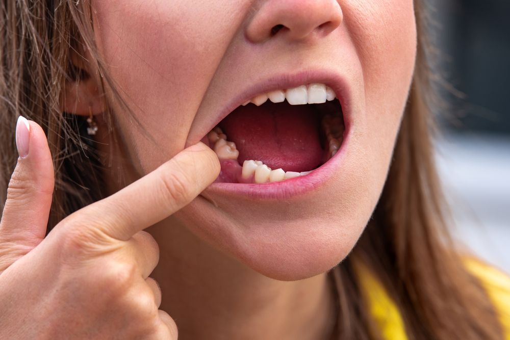 A Woman Is Pointing At Her Missing Tooth In Her Mouth — Mittagong Dental Care In Mittagong, NSW
