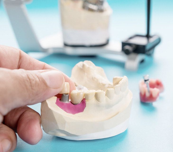 A Person Is Holding A Model Of A Dental Bridge In Their Hand — Mittagong Dental Care In Mittagong, NSW