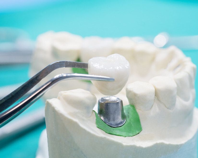 A Close Up Of A Model Of A Tooth With A Crown On It — Mittagong Dental Care In Mittagong, NSW