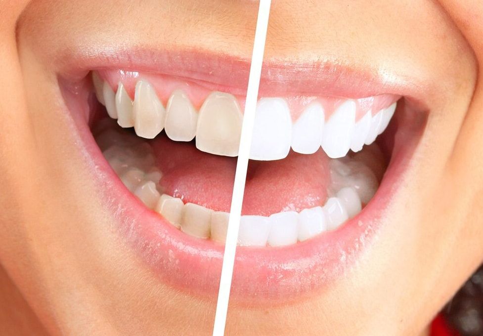 A Close Up Of A Woman's Teeth Before And After Whitening — Mittagong Dental Care In Mittagong, NSW