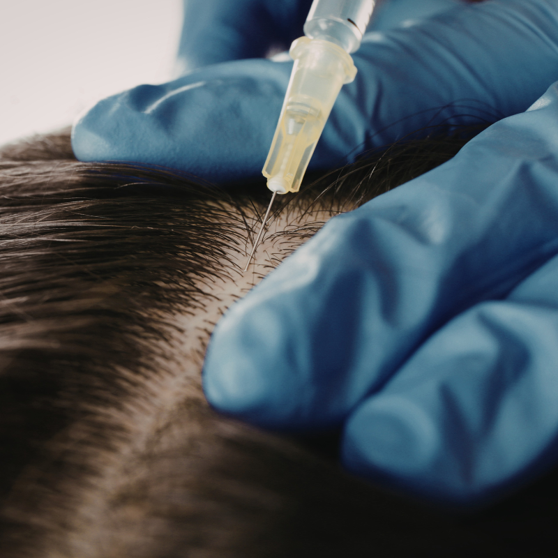 Gloved hands applying liquid to parted scalp with a dropper