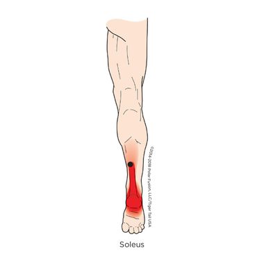 A drawing of a person 's leg with a red spot on the soleus.