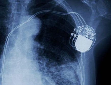 DR. JOSÉ R. AMAVIZCA MARTÍNEZ CLÍNICA CARDIOVASCULAR -  marcapasos