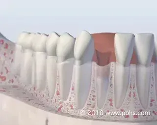 A computer generated image of a person 's teeth and gums.