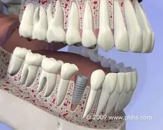 A model of a person 's teeth with a dental implant in the middle
