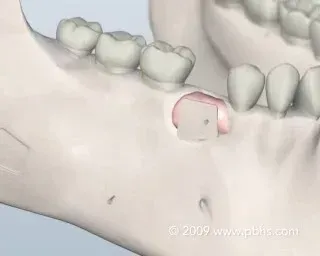 bone grafting