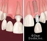 Dental Implants versus Fixed Bridgework—Which Option is Best for You?