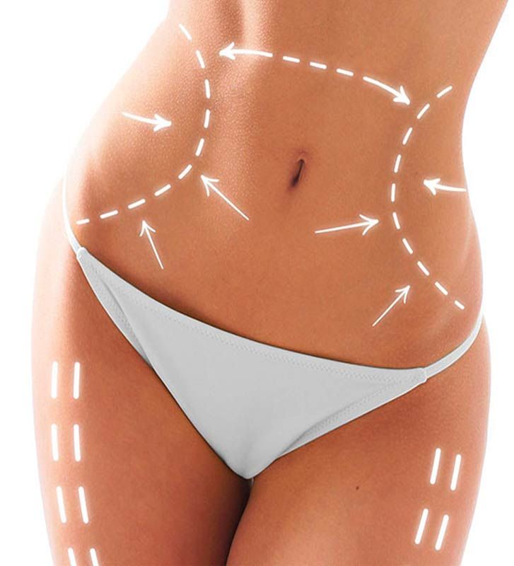 Abdomen con marcación de zonas para moldeo corporal