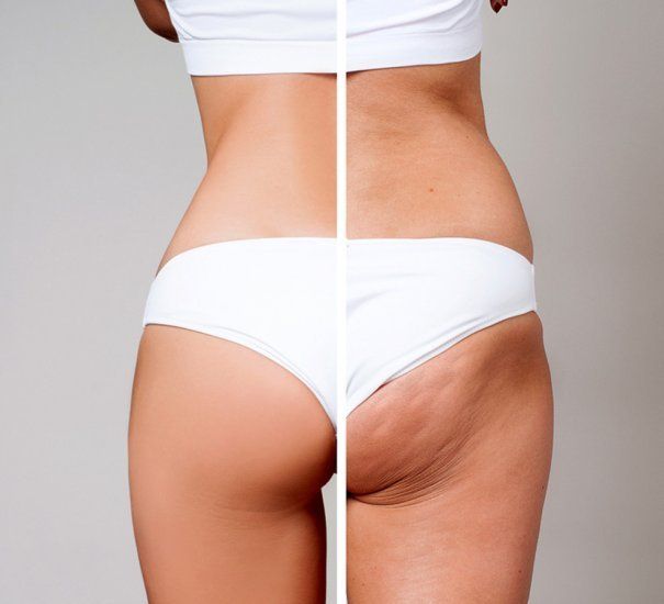 Antes y después de celulitis en piernas y glúteos