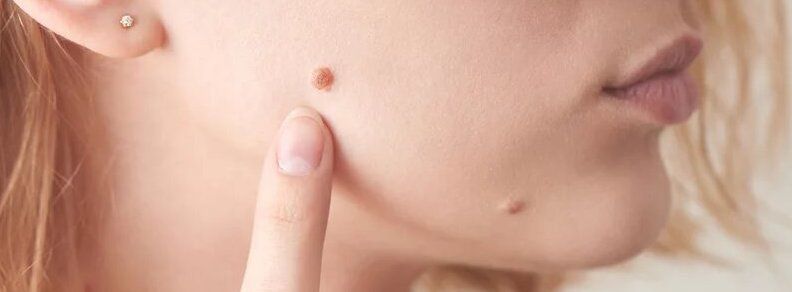 Primer plano de lunar en el rostro