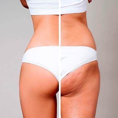 Antes y después de tratamiento corporal en cintura y espalda