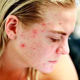 Acné facial en imagen de tratamiento dermatológico
