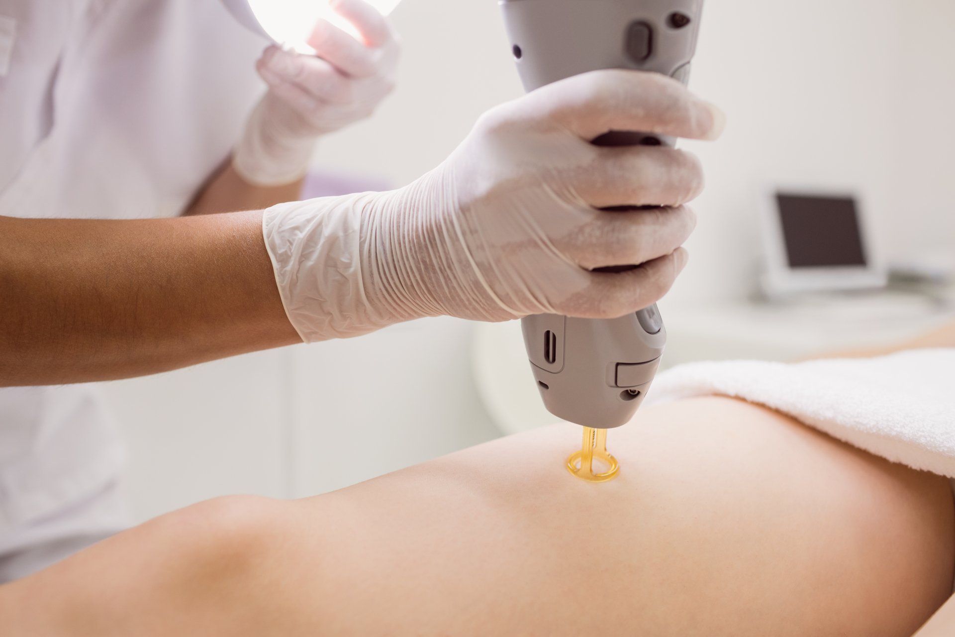 Depilación laser