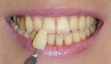 Denti con una scala cromatica dentale appoggiata al dente frontale durante una prova di abbinamento del colore dentale