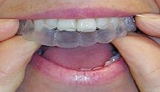 Bocca con allineatore dentale trasparente che viene applicato sui denti superiori con le dita