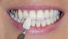 Primo piano di una bocca sorridente con denti di colore abbinato utilizzando una cartella colori dentale.