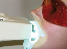 Denti sbiancati con un bite luminoso e occhiali protettivi rossi.