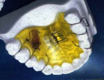 Protesi dentaria con apparecchio ortodontico color giallo e piccole staffe metalliche su sfondo blu scuro.