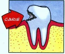 Dente con carie visibile e freccia rossa con la scritta