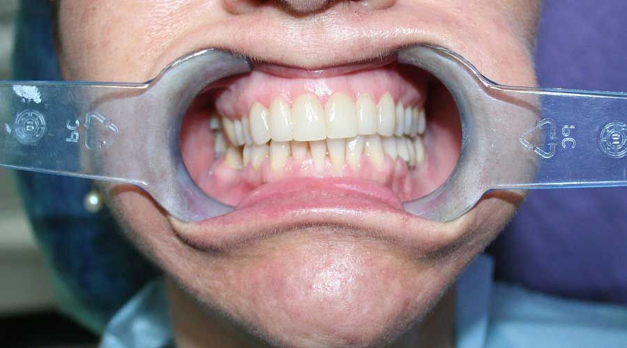 Bocca retratta mediante divaricatori odontoiatrici per le guance, in modo da mostrare denti e gengive per un esame orale.