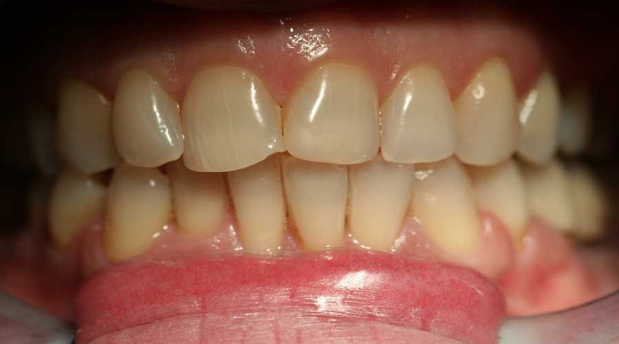 Primo piano di una bocca che mostra denti e gengive con le labbra tirate indietro in un sorriso