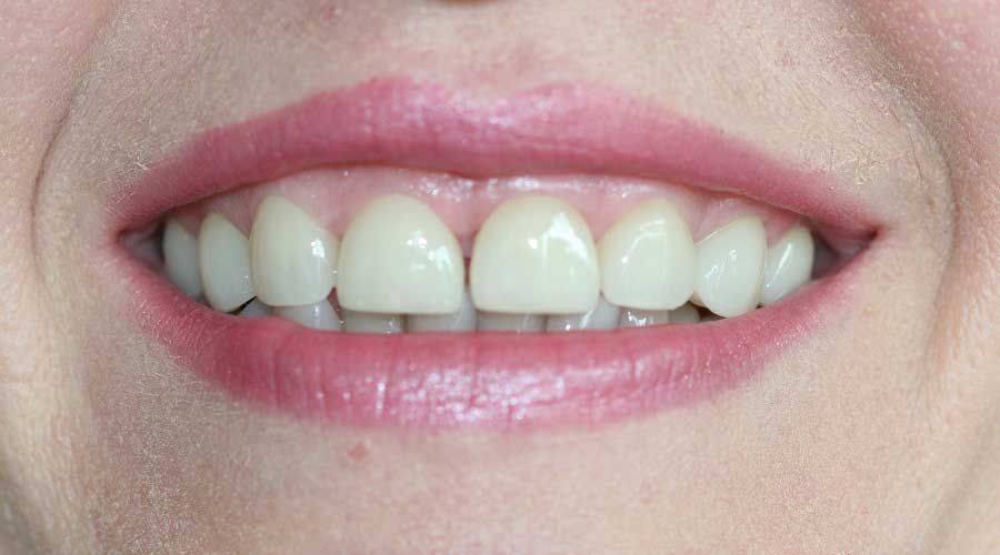 Primo piano di una bocca sorridente con denti bianchi e labbra rosa