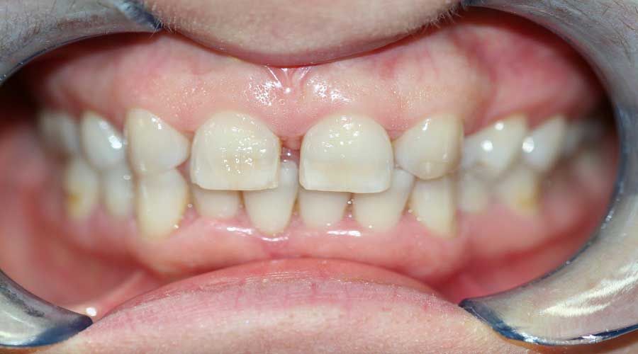 Primo piano di denti con uno spazio visibile tra gli incisivi e un divaricatore orale