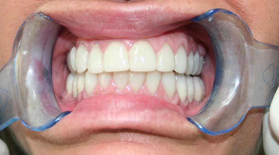 Primo piano di una bocca che regge dei divaricatori per le guance trasparenti