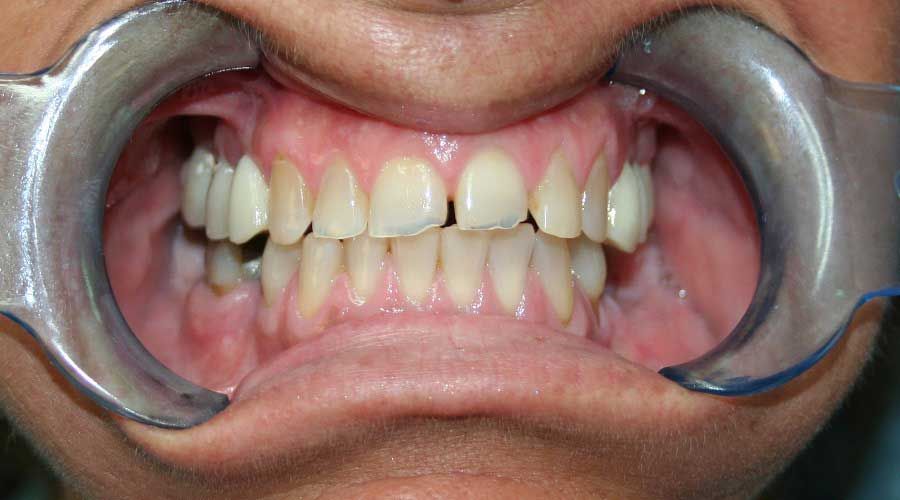 Primo piano di una bocca tenuta aperta da divaricatori metallici, che mostra denti e gengive superiori e inferiori.