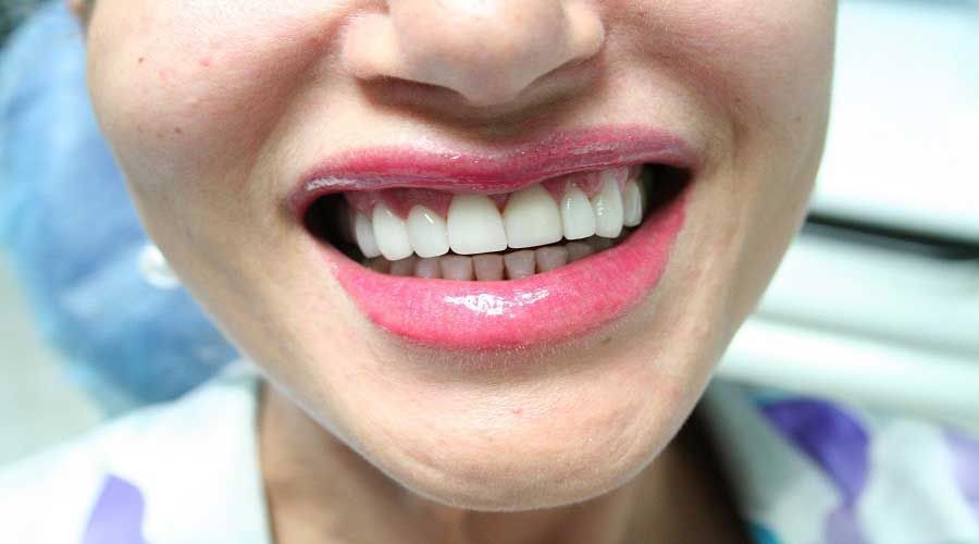 Primo piano di una bocca sorridente con rossetto rosa, che mostra i denti bianchi
