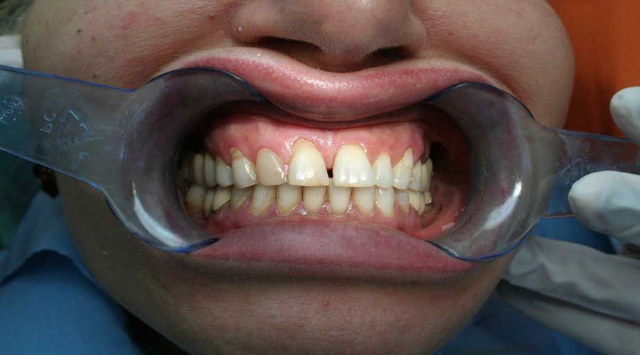 Bocca retratta con divaricatori per le guance, che mostrano i denti superiori e inferiori durante una visita odontoiatrica.
