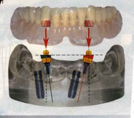 Schema di un ponte dentale su impianti con protesi superiore e impianti nella mandibola; 