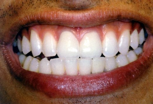 Primo piano di una bocca sorridente che mostra denti bianchissimi e labbra rosse.