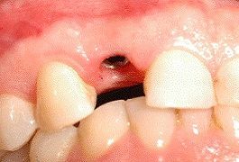Primo piano della bocca di un bambino che mostra un incisivo superiore mancante e una piccola macchia scura sulla gengiva.