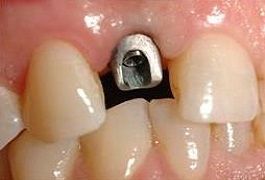 Primo piano di un dente frontale con un moncone di impianto dentale metallico esposto tra i denti
