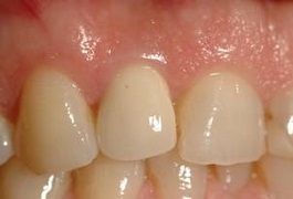 Primo piano dei denti frontali con spazi evidenti e una leggera decolorazione giallastra.