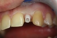 Primo piano di denti con un incisivo mancante e un piccolo perno dentale bianco visibile nello spazio vuoto.