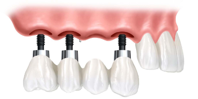 3 impianti dentali a supporto di denti frontali sostitutivi sotto gengive rosa