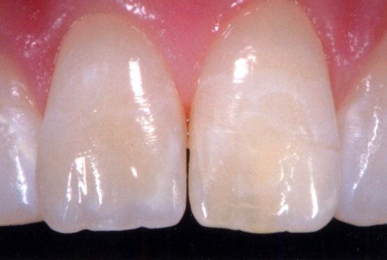 Primo piano di due incisivi centrali con una decolorazione bianco-giallastra su uno di essi.