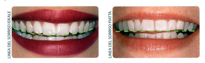 Primi piani affiancati di labbra e denti con un apparecchio ortodontico verde, che mostrano il prima e il dopo.