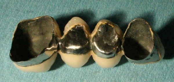 Ponte dentale con quattro denti ricoperti da capsule dorate su sfondo verde acqua.