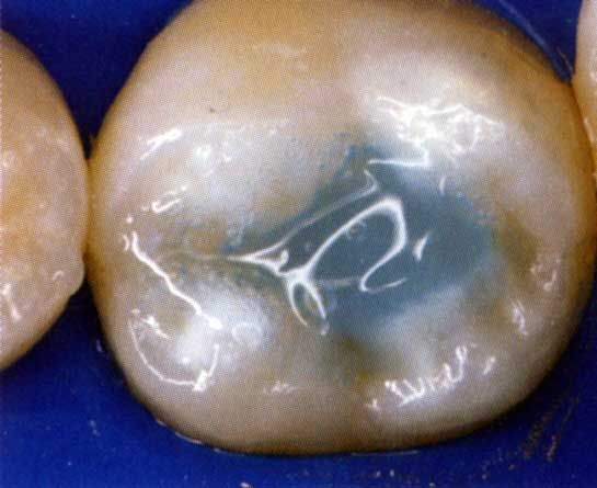 Primo piano di un dente molare con un'otturazione dentale color argento scuro.