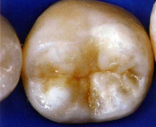Primo piano di un dente molare con macchie di carie brunastre e scolorimento dello smalto.