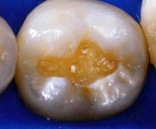 Primo piano di un dente con una carie di colore arancio-marrone sulla superficie masticatoria.