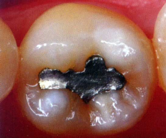 Primo piano di un dente con un'otturazione in amalgama d'argento circondata da gengive rosa.
